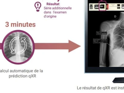 grace-a-lintelligence-artificielle-lhopital-foch-performe-ses-diagnostics-grace-a-la-lecture-automatique-de-radiographies-thoraciques-se-basant-sur-une-data-de-plus-de-35-millions-de-cliches