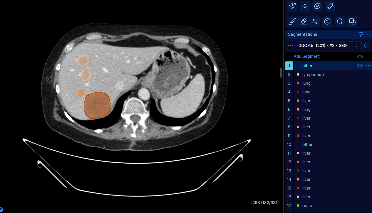 Illustration Un nouvel outil d’IA au service d’une détection optimale du cancer par imagerie